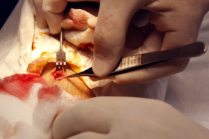 Surgical removal of object in Patient Seventeen’s leg