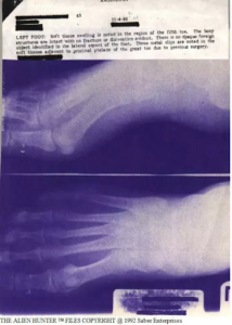 X-Rays of Patricia’s Implants